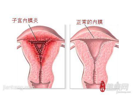 子宫内膜炎的病因是什么?